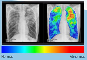 SYST.D'AIDE DECISION MEDIC.RX THORAX TB, CAD4TB 5000lectures