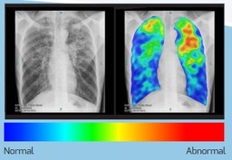 [EDIMXRSE01-] CHEST X-RAY COMPUTER-AIDED DETECTION TB, CAD4TB perp.license